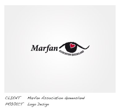 marfan